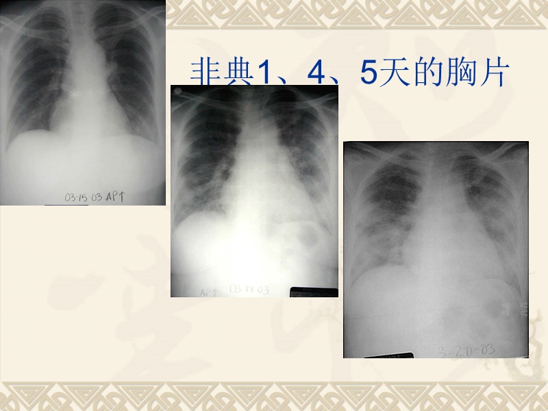 呼吸机的急诊应用.ppt_第2页