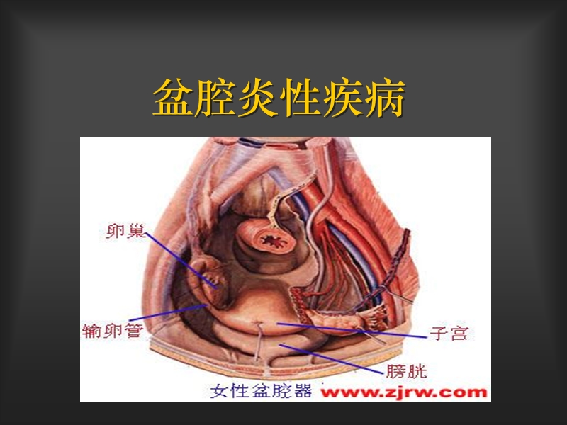 盆腔炎-20150401.ppt_第1页