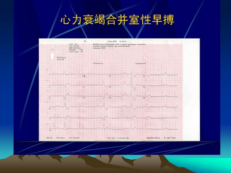 心力衰竭患者室性心律失常的药物治疗.ppt_第3页