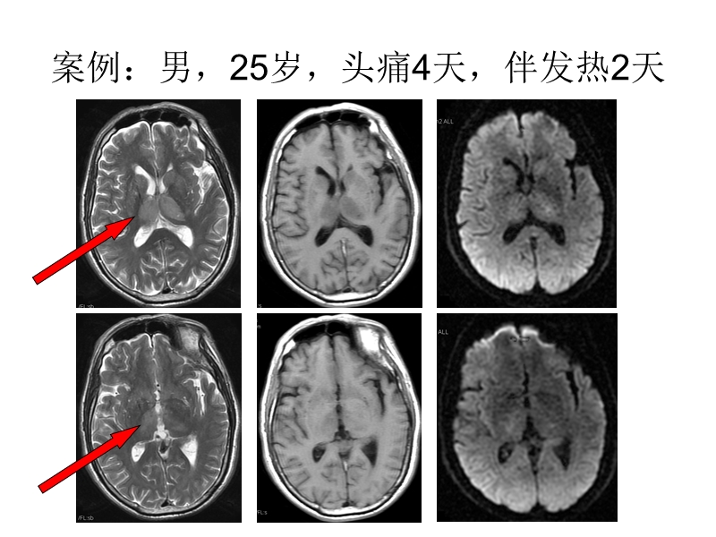 大脑内静脉及其属支的mrv成像研究.ppt_第3页