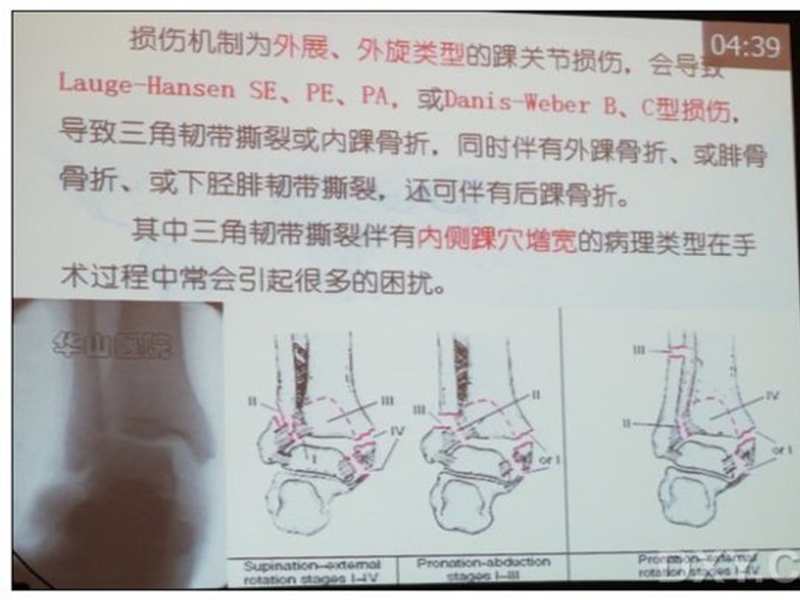 影响踝穴复位因素.ppt_第3页