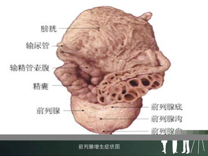 前列腺电切术的护理.ppt_第3页