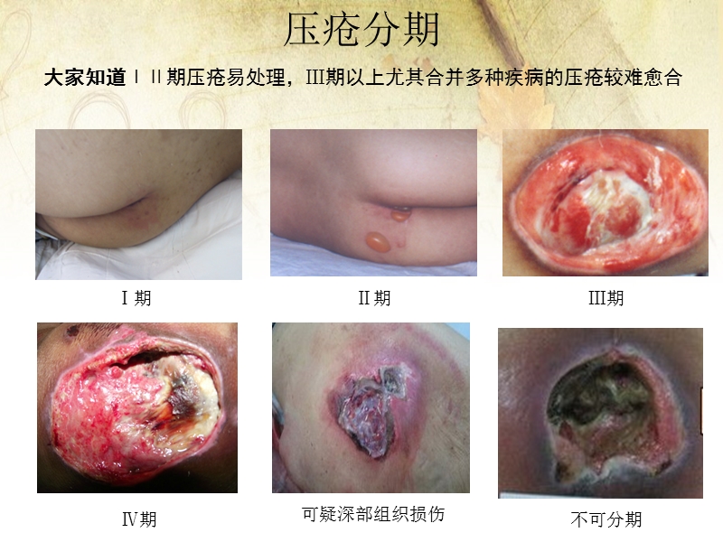 压疮个案护理查房.ppt_第2页