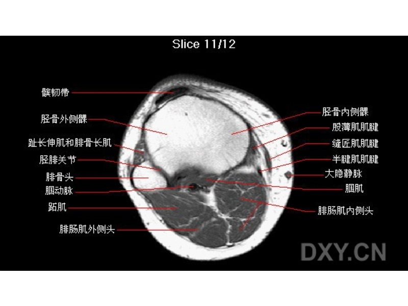 膝部mri解剖.ppt_第2页