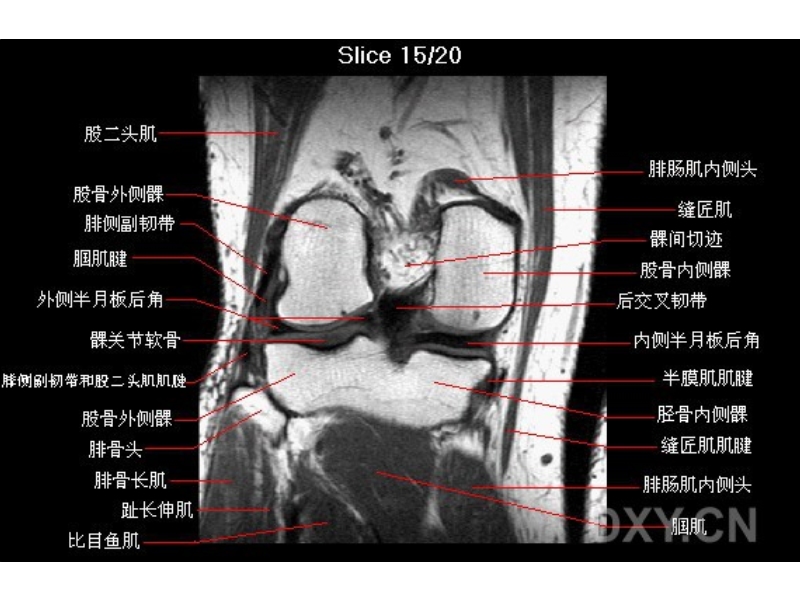 膝部mri解剖.ppt_第3页