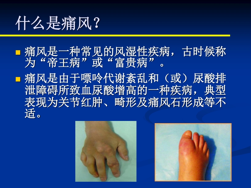 痛风健康科普讲座.ppt_第2页