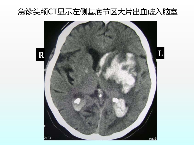 老年卒中患者肠内营养实施规范.pptx_第3页