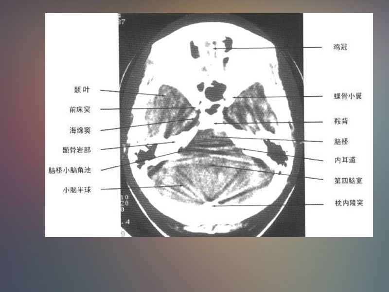 正常头颅ct及mri解剖.ppt_第3页