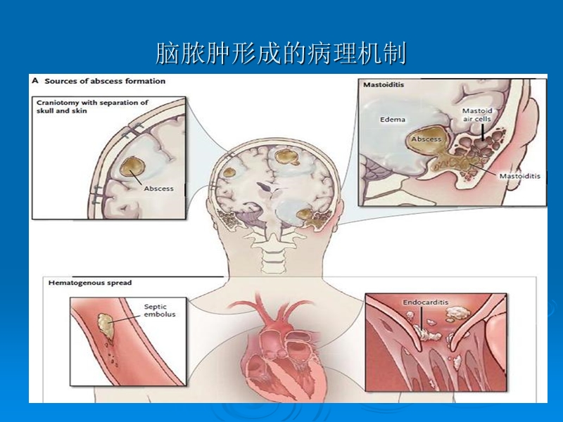 新英格兰杂志2014年脑脓肿治疗进展.ppt_第3页