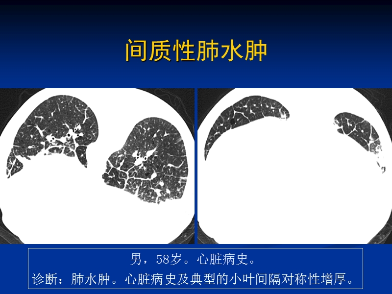 不同类型肺水肿的ct表现.ppt_第3页