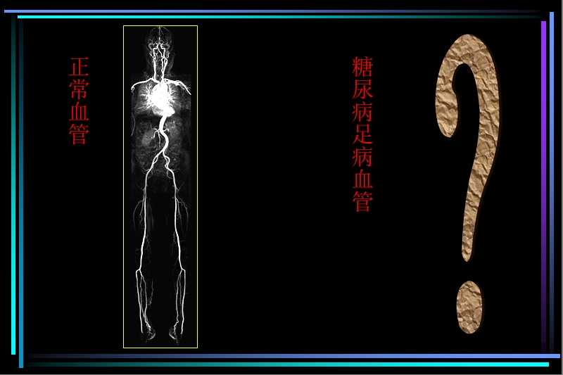 ce-mra对糖尿病足血管病变的诊断价值.ppt_第2页