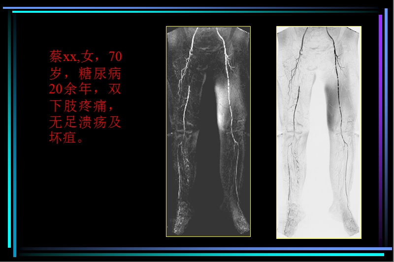 ce-mra对糖尿病足血管病变的诊断价值.ppt_第3页