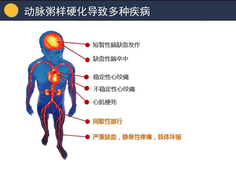 下肢动脉硬化闭塞症.ppt_第3页