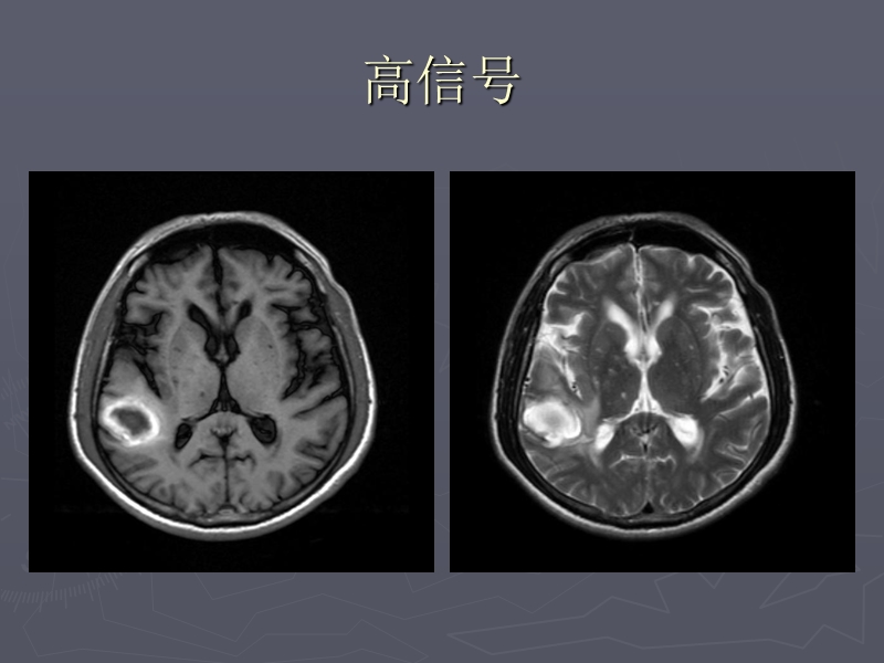 中枢神经系统mri阅片基本技能.ppt_第3页