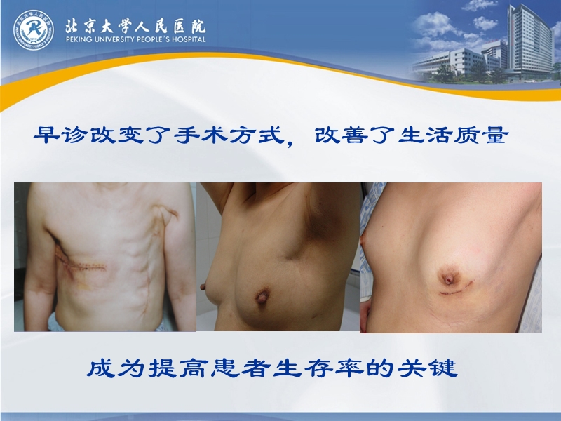 乳腺癌的早期诊断_2015.ppt_第2页