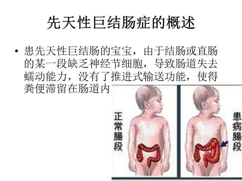 先天性巨结肠症的观察和护理.pptx_第3页