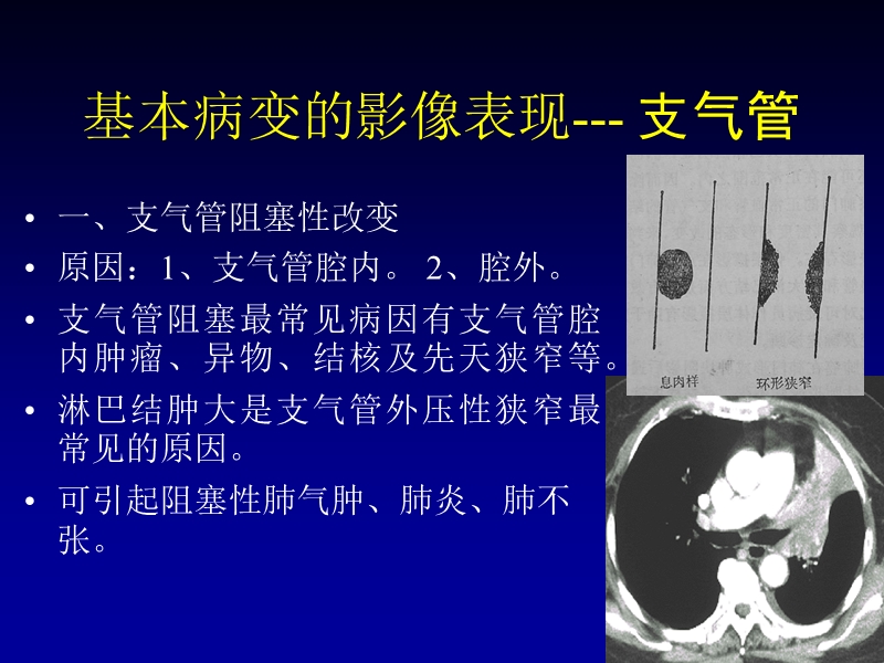 呼吸系统基本病变3.ppt_第3页