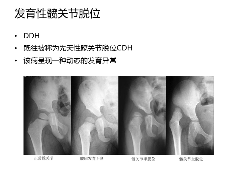 发育性髋关节脱位筛查方法.ppt_第2页