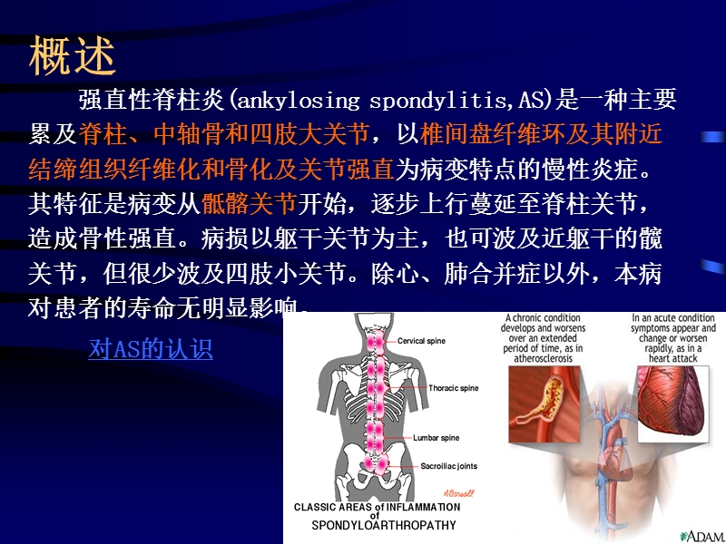 强直性脊柱炎.ppt_第3页