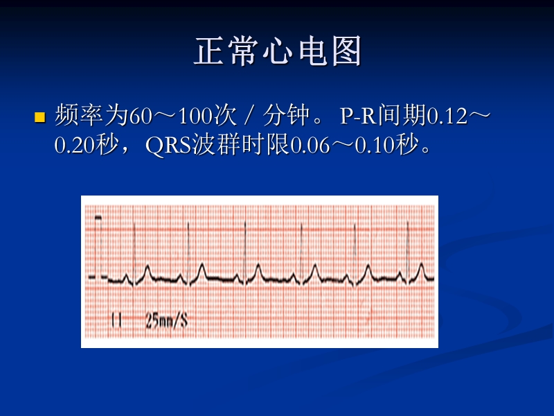 心电监护常见图形.ppt_第3页