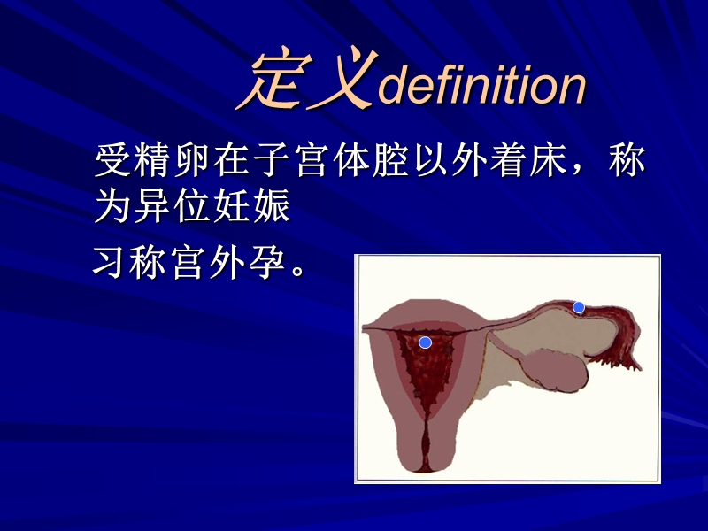 异位妊娠(课件).ppt_第2页