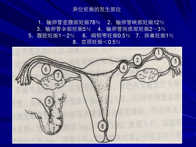 异位妊娠(课件).ppt_第3页