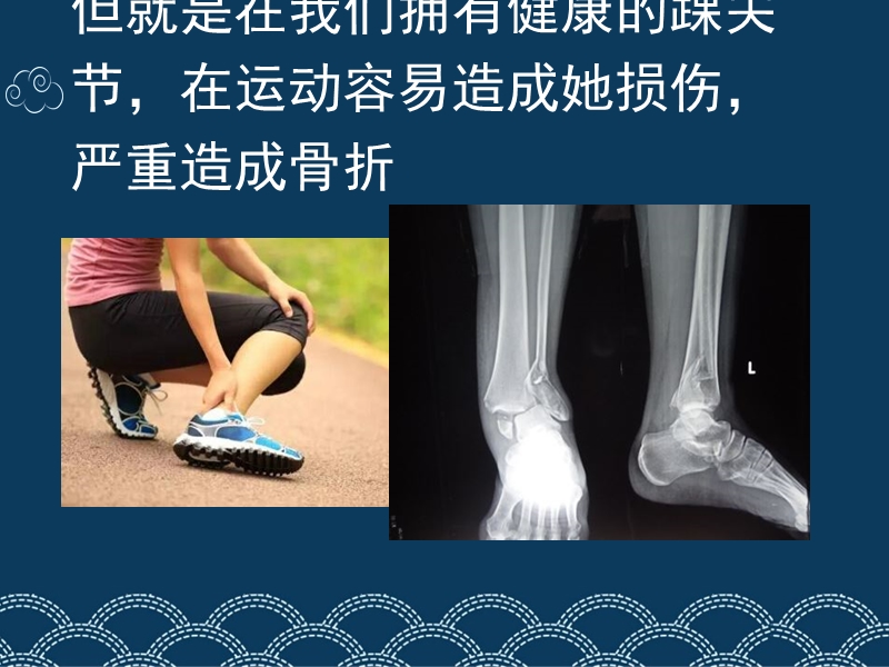 踝部骨折护理.ppt_第3页