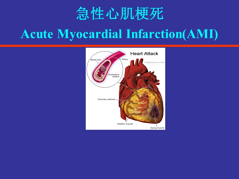 急性心肌梗死(1).ppt_第1页