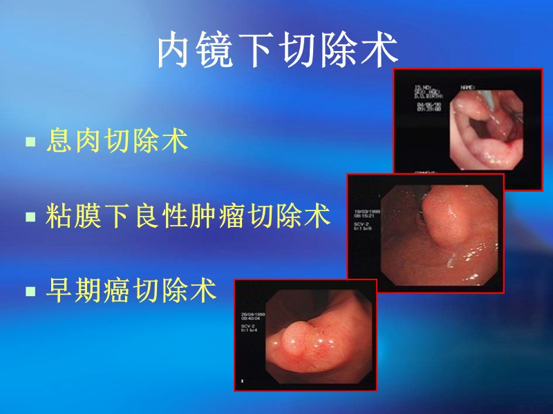 内镜下粘膜切除术.ppt_第3页