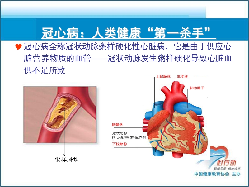 冠心病患者pci术后健康教育-新(一).ppt_第3页