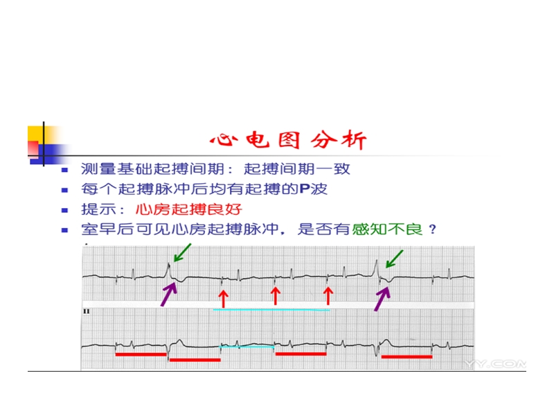 单腔起搏心电图.ppt_第2页