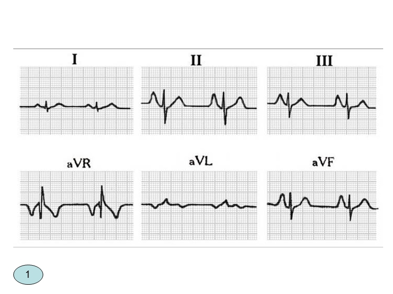 快速阅读心电图.ppt_第3页