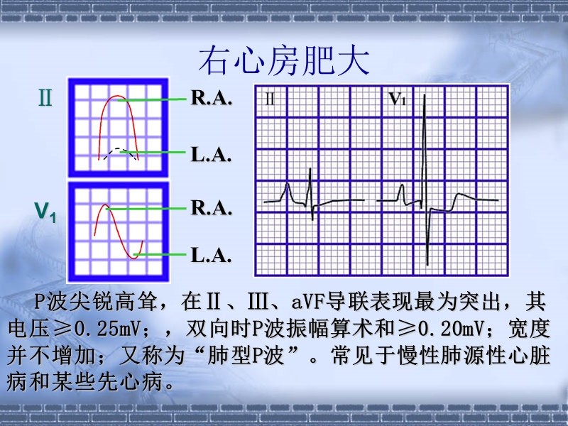 心电图的临床应用1.ppt_第3页