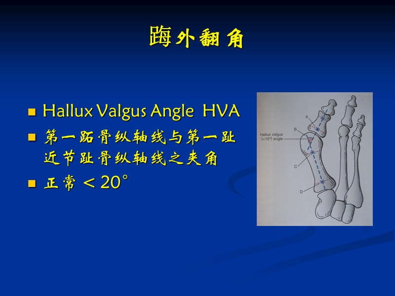 改良chevron手术和akin手术.ppt_第3页