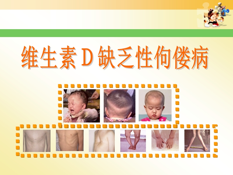 佝偻病患儿护理.ppt_第3页