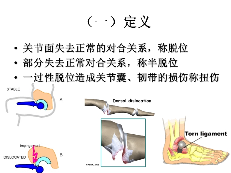 关节脱位.ppt_第3页