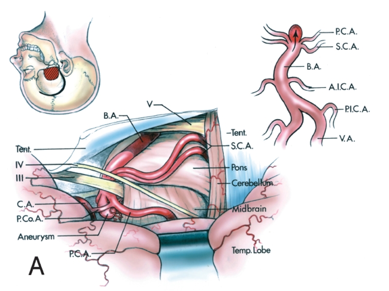 后循环动脉瘤手术入路.ppt_第3页