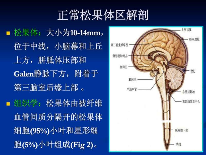 松果体细胞瘤.ppt_第2页