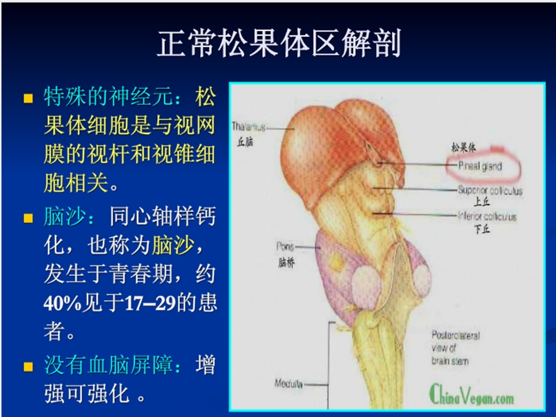 松果体细胞瘤.ppt_第3页