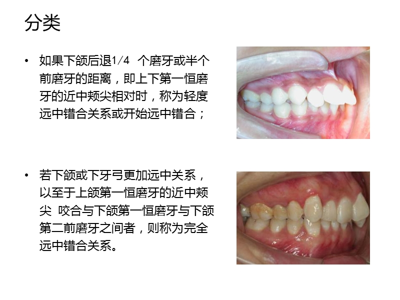 安氏ii类错合的矫治.ppt_第3页