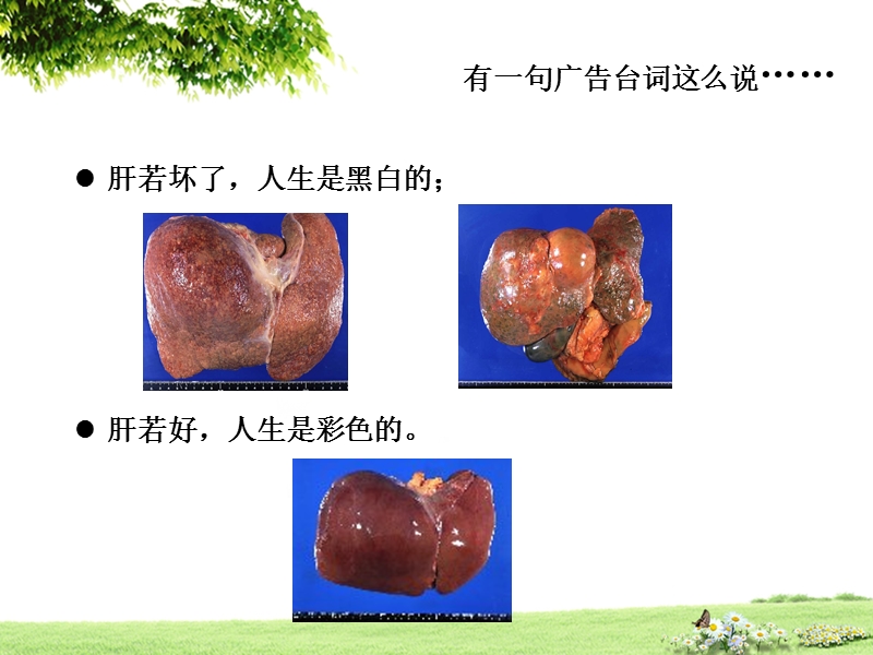 肝功能衰竭.ppt_第3页