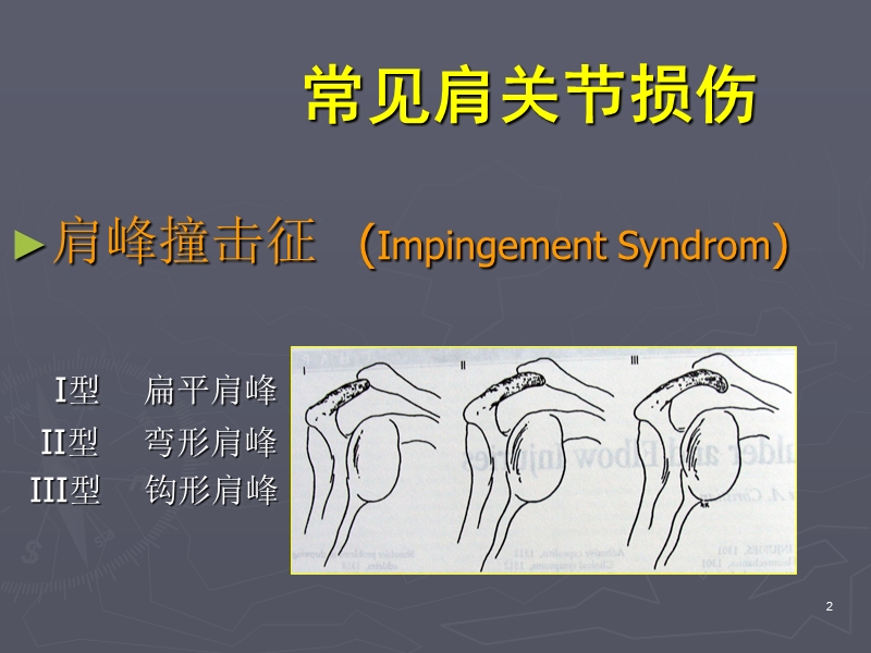 肩关节镜手术期护理要点.ppt_第2页