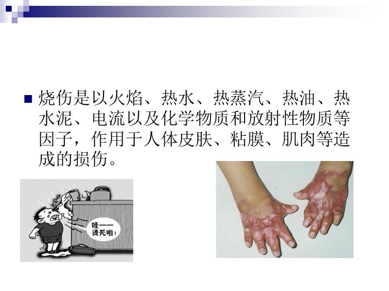 烧伤的作业治疗.ppt_第2页