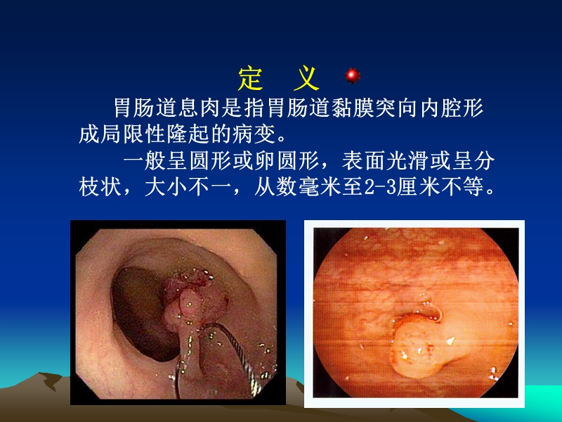 胃肠道息肉内镜下电凝切除术.ppt_第2页