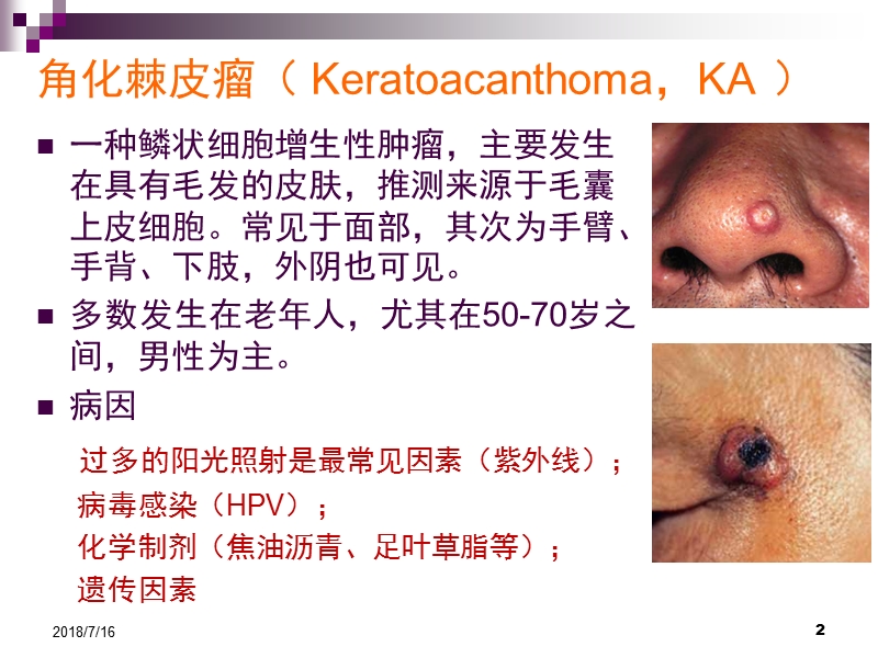 角化棘皮瘤.pptx_第2页