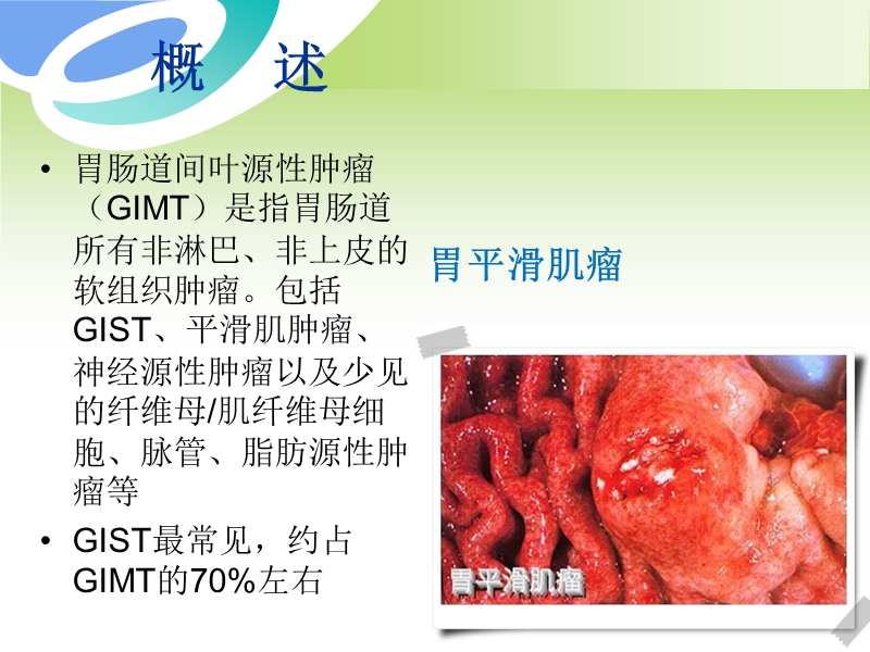 胃肠道间质瘤ct诊断与鉴别诊断.pptx_第3页