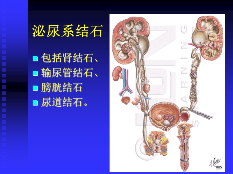 泌尿系结石.ppt_第2页