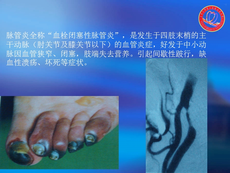 血栓闭塞性脉管炎.ppt_第2页