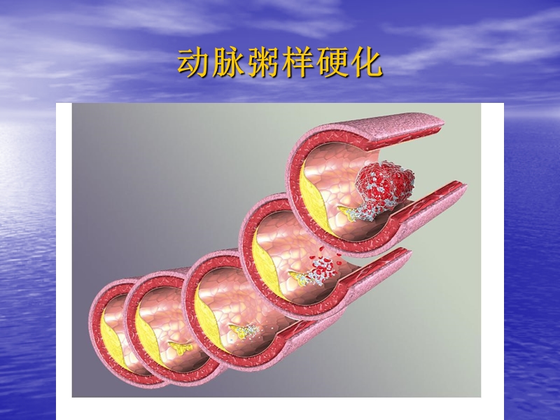 常见疾病 动脉粥样硬化.ppt_第1页