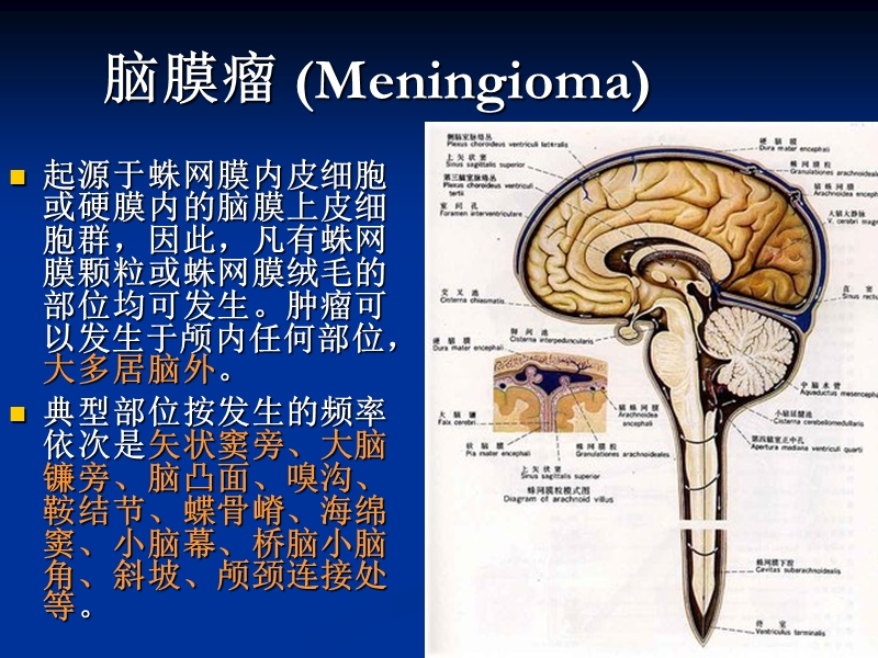 脑膜瘤mri诊断.ppt_第3页